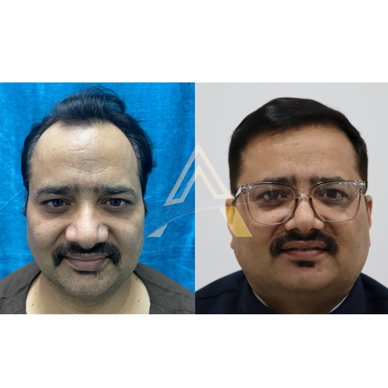 hair transplant before after results